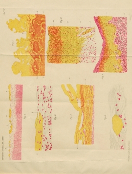 G06_1Fibrinoiede_Degeneration